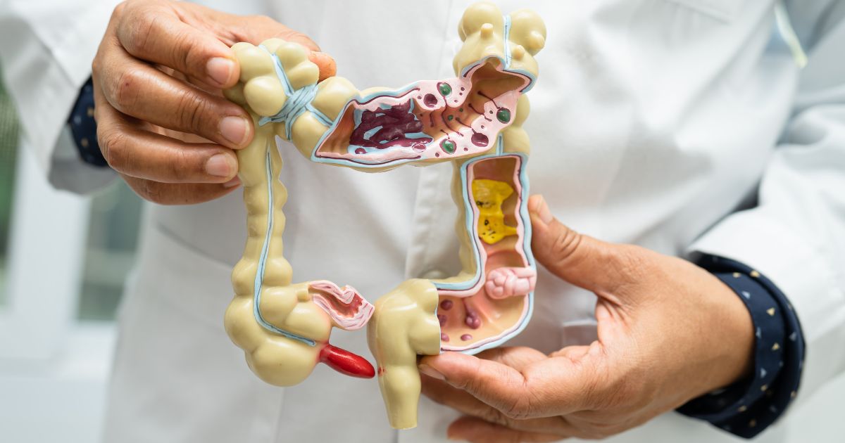 Representação do Intestino Grosso humano para abordar a doença diverticular e a diverticulite